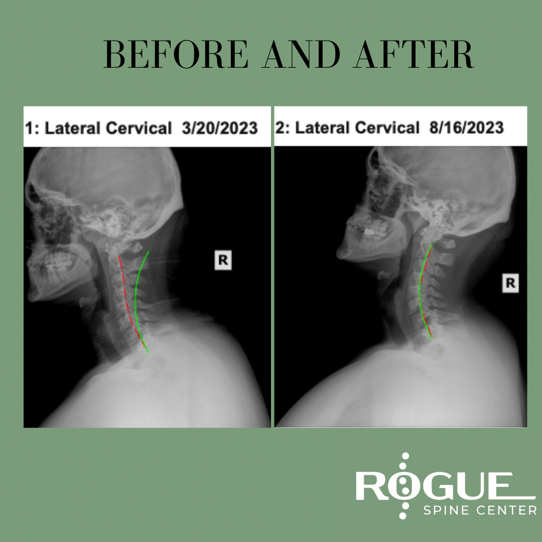 Neck Chiropractic Care Before and After X-rays