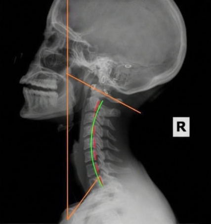 Follow-up neck X-ray after 10 weeks showing the patient's cervical curve closer to the clinic's reference line