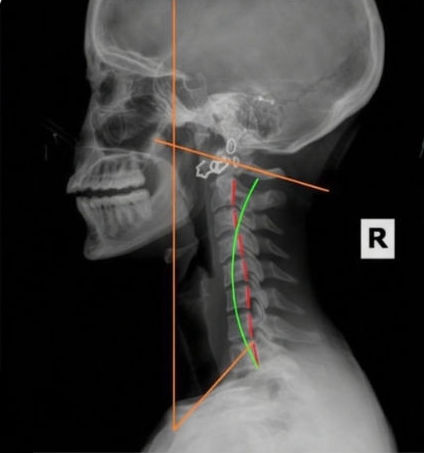 Before-treatment neck X-ray showing a reduced cervical curve compared with the clinic's reference line