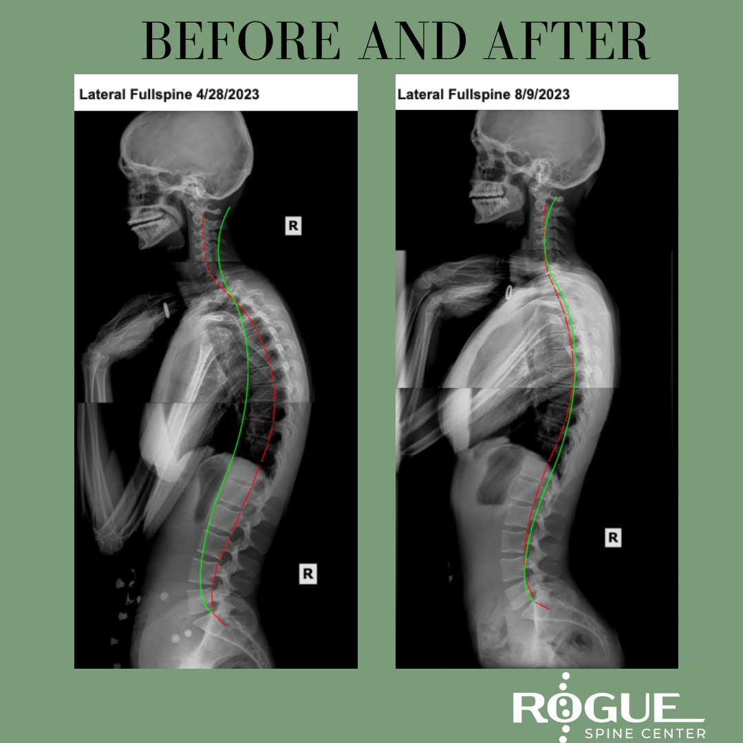 Full Spine Chiropractic Care Before and After X-rays